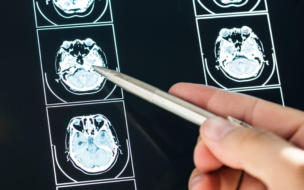closeup-brain-mri-scan-result
